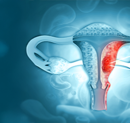 Endometriumkarzinom banner bild